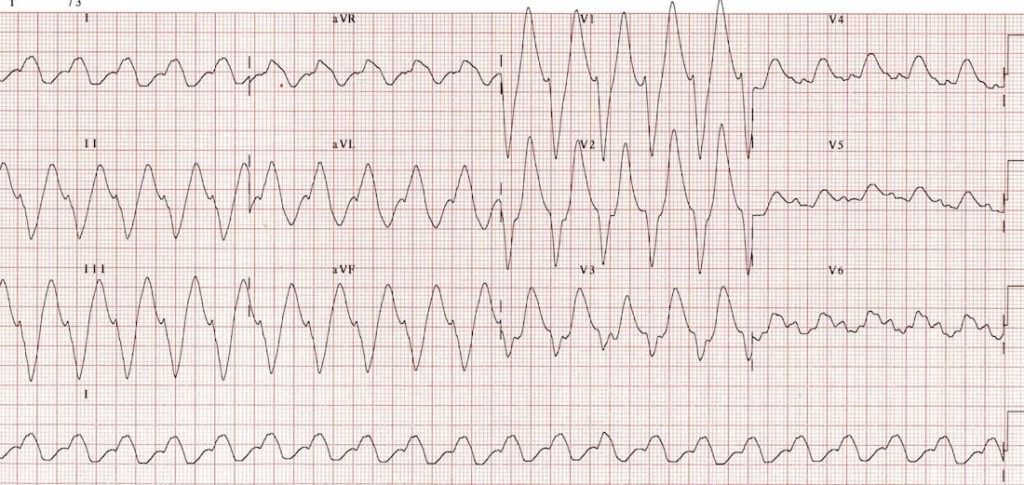 TOP 100 ECG QUIZ LITFL 056