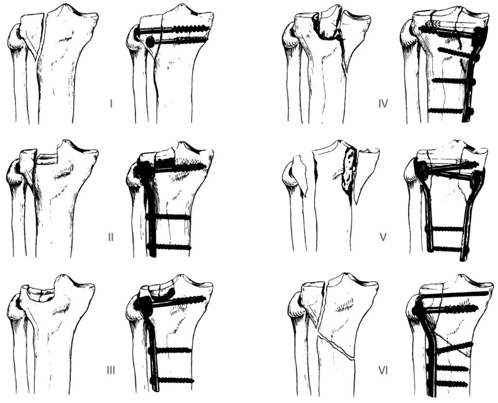 Schatzker Classification Of Tibial Plateau Fractures LITFL Eponym Schatzker Classification Of Tibial Plateau Fractures LITFL Eponym