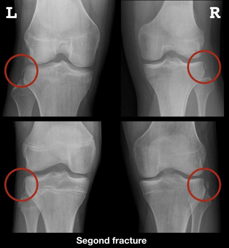 Segond Fracture LITFL Medical Blog Medical Eponym Library