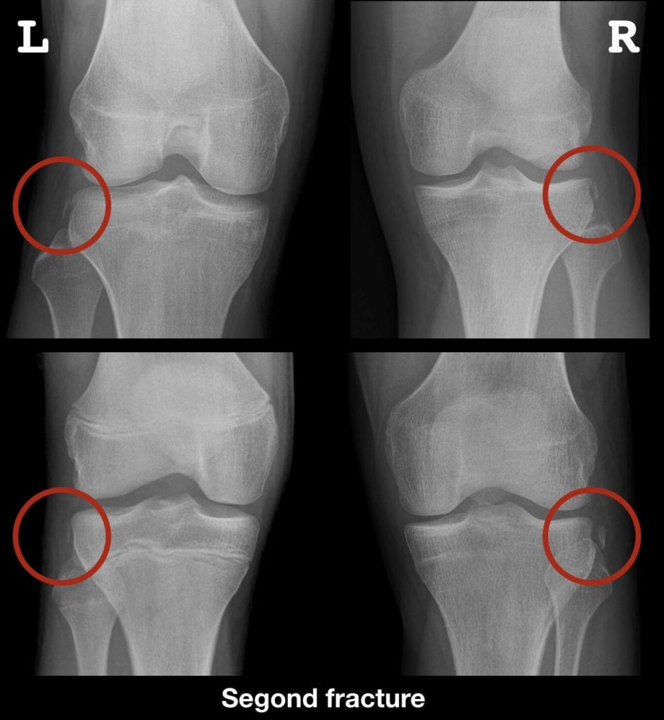Segond Fracture LITFL Medical Blog Medical Eponym Library Segond Fracture LITFL Medical Blog Medical Eponym Library