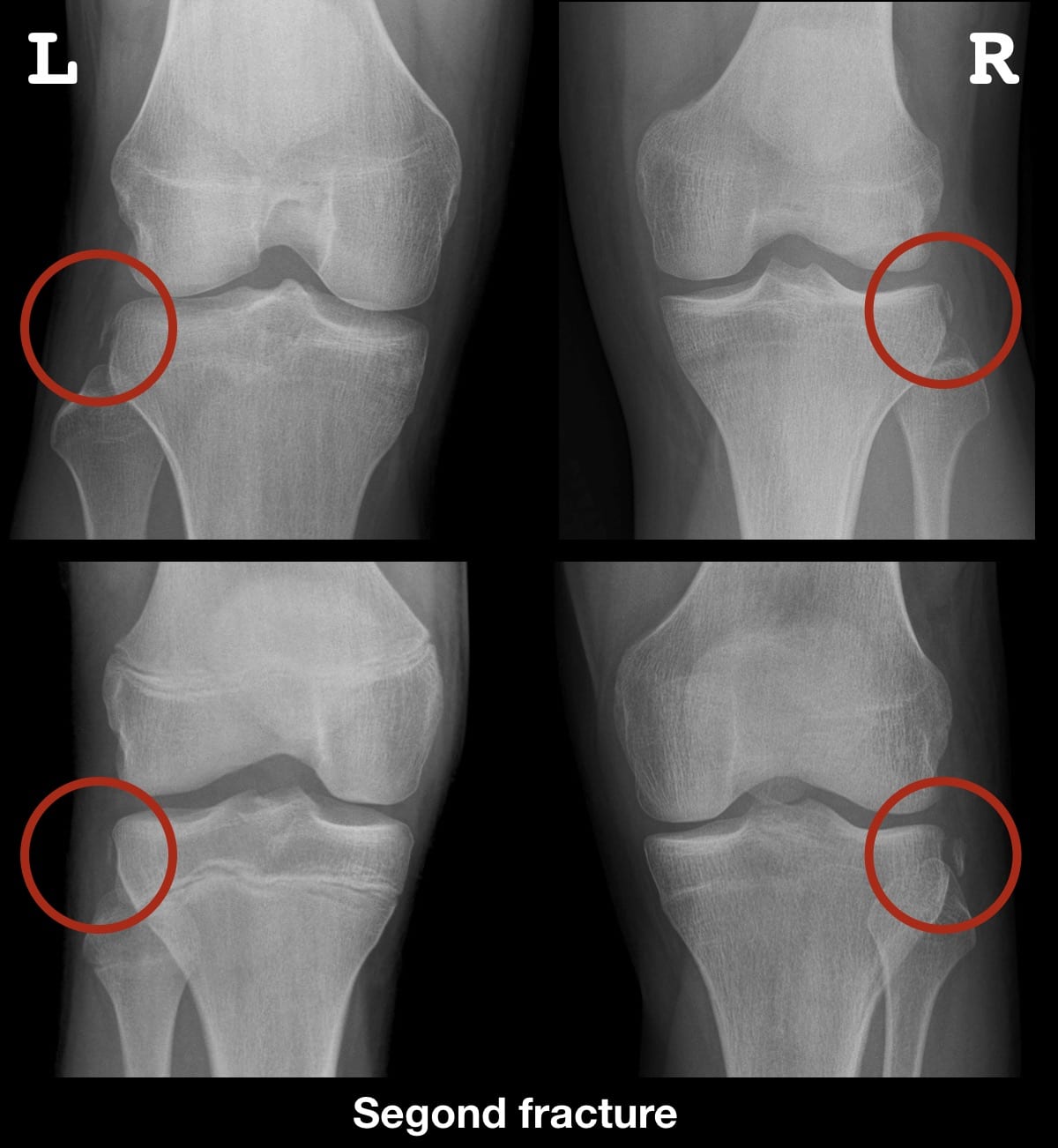 xray of broken knee