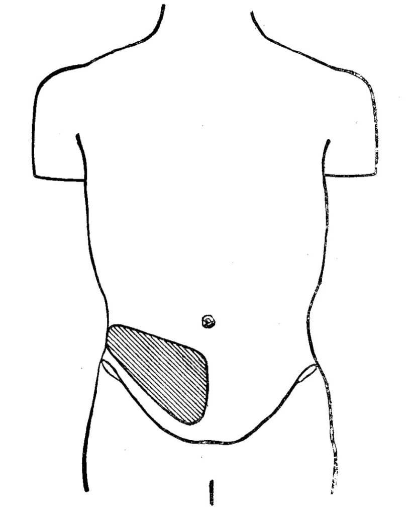 Sherren-triangle-of-cutaneous-hyperalgesia-appendicitis 1903