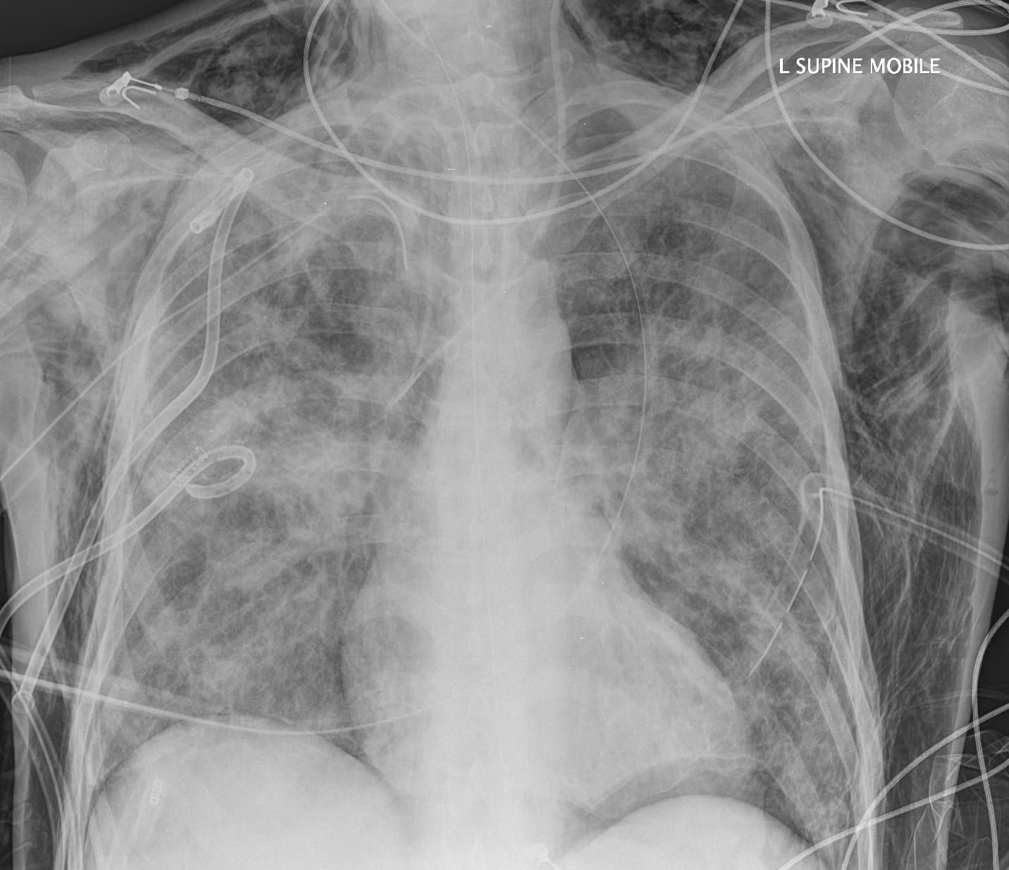 Ballooning Up Litfl Clinical Cases Pulmonary Puzzler