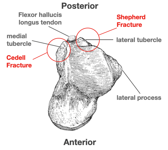 medial tubercle of talus