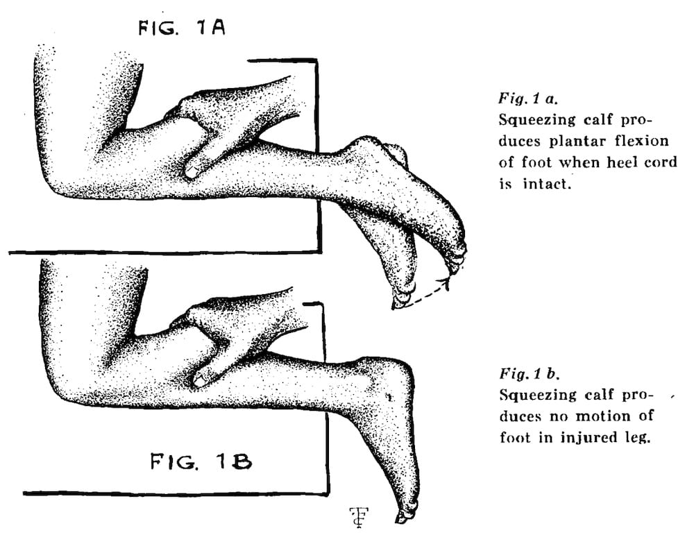 Simmonds-Thompson Test • LITFL • Medical Eponym Library