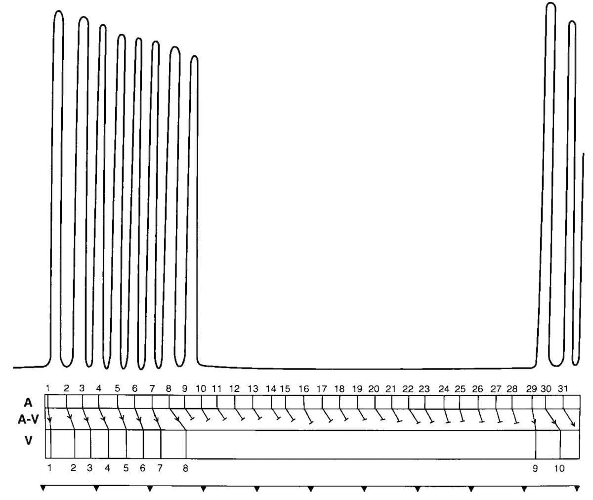 AV block: 3rd degree (complete heart block) • LITFL • ECG Library