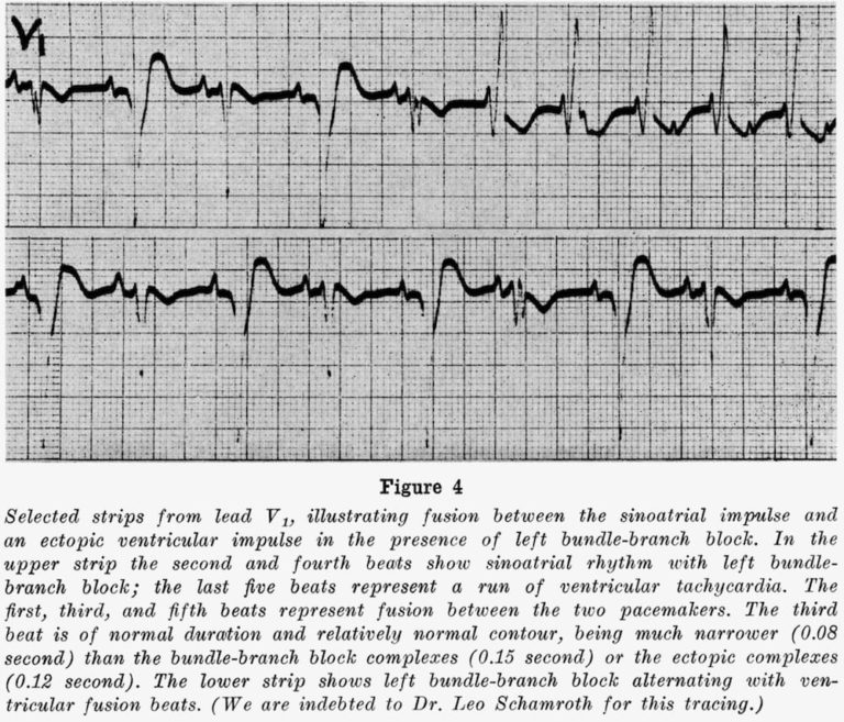 Dressler beat • LITFL • Medical Eponym Library