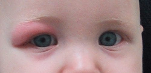 periorbital cellulitis infant