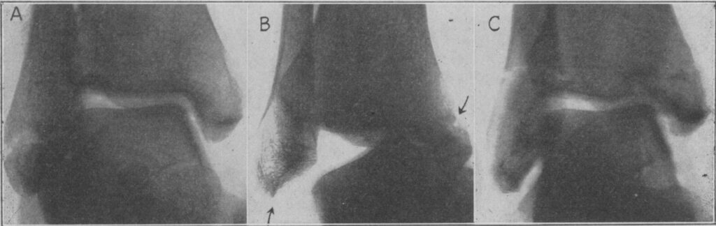 supination-adduction SAD fracture