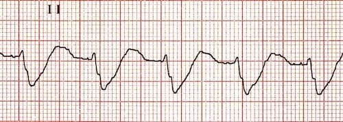 Broad-QRS-no-P-waves-hyperk