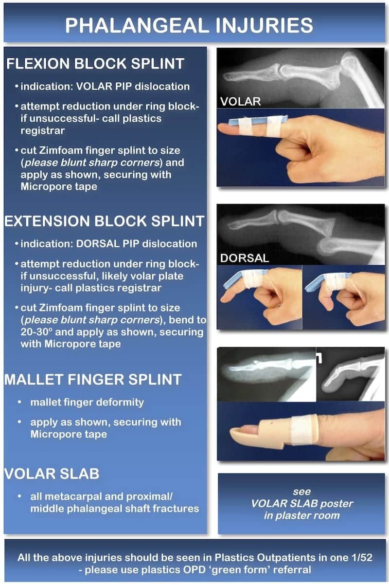 colles fracture backslab