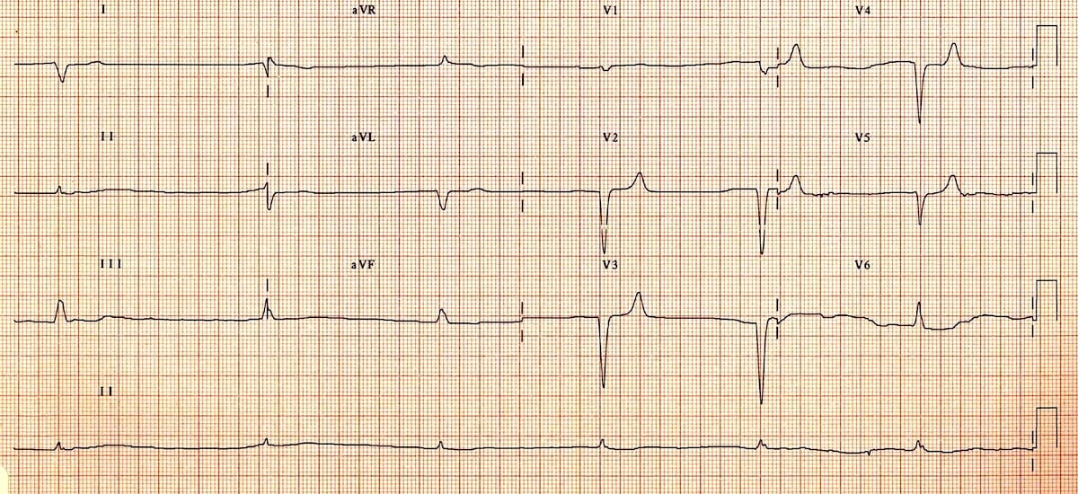 Is Borderline ECG Dangerous? Understanding Your ECG Reports