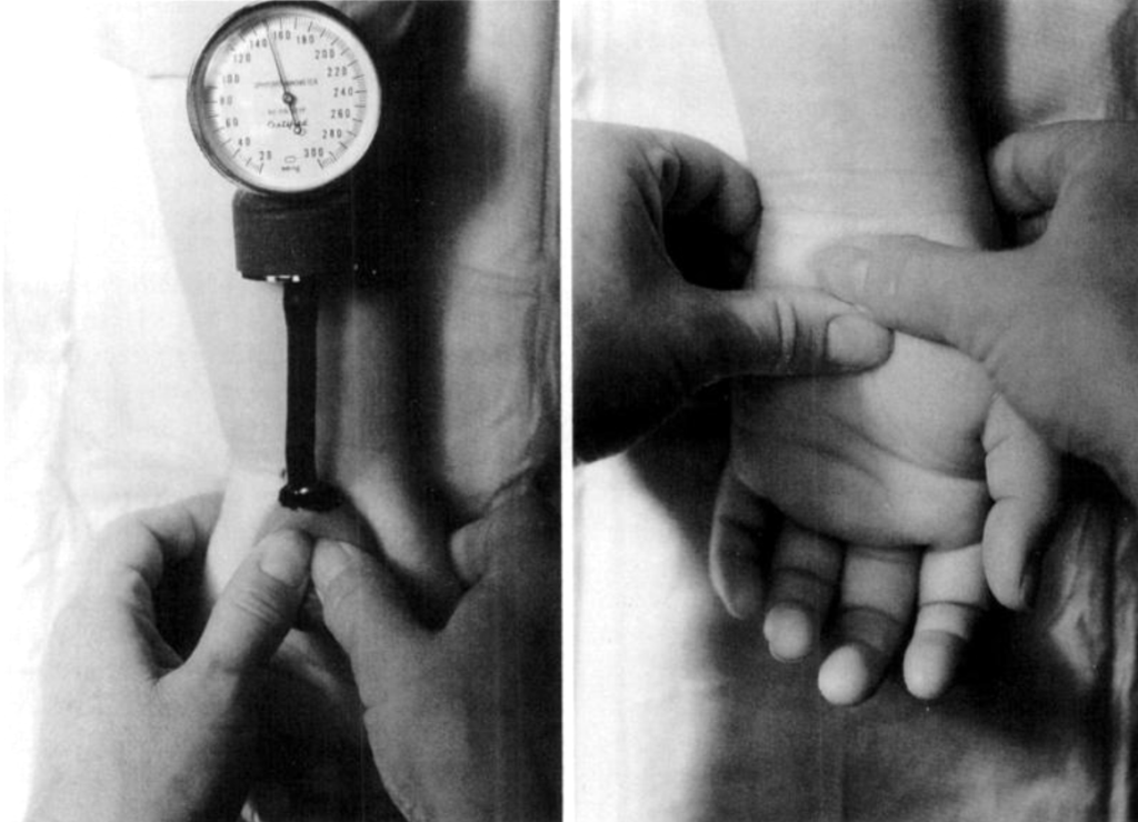 Durkan test 1991