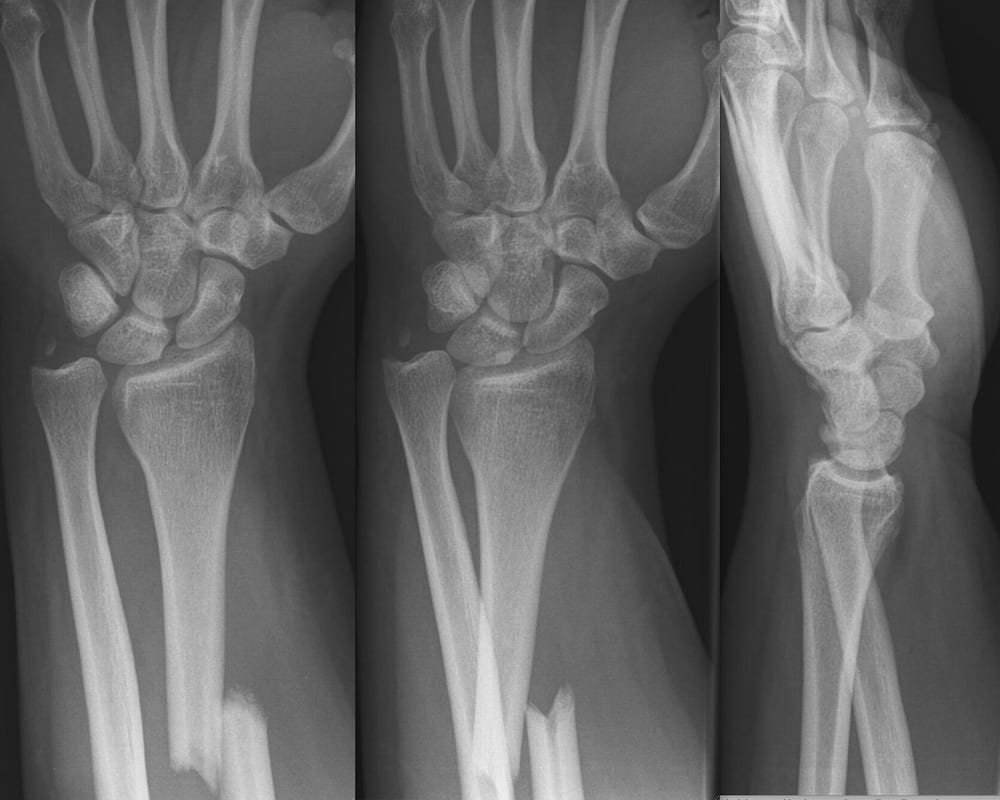 closed galeazzi fracture of left radius