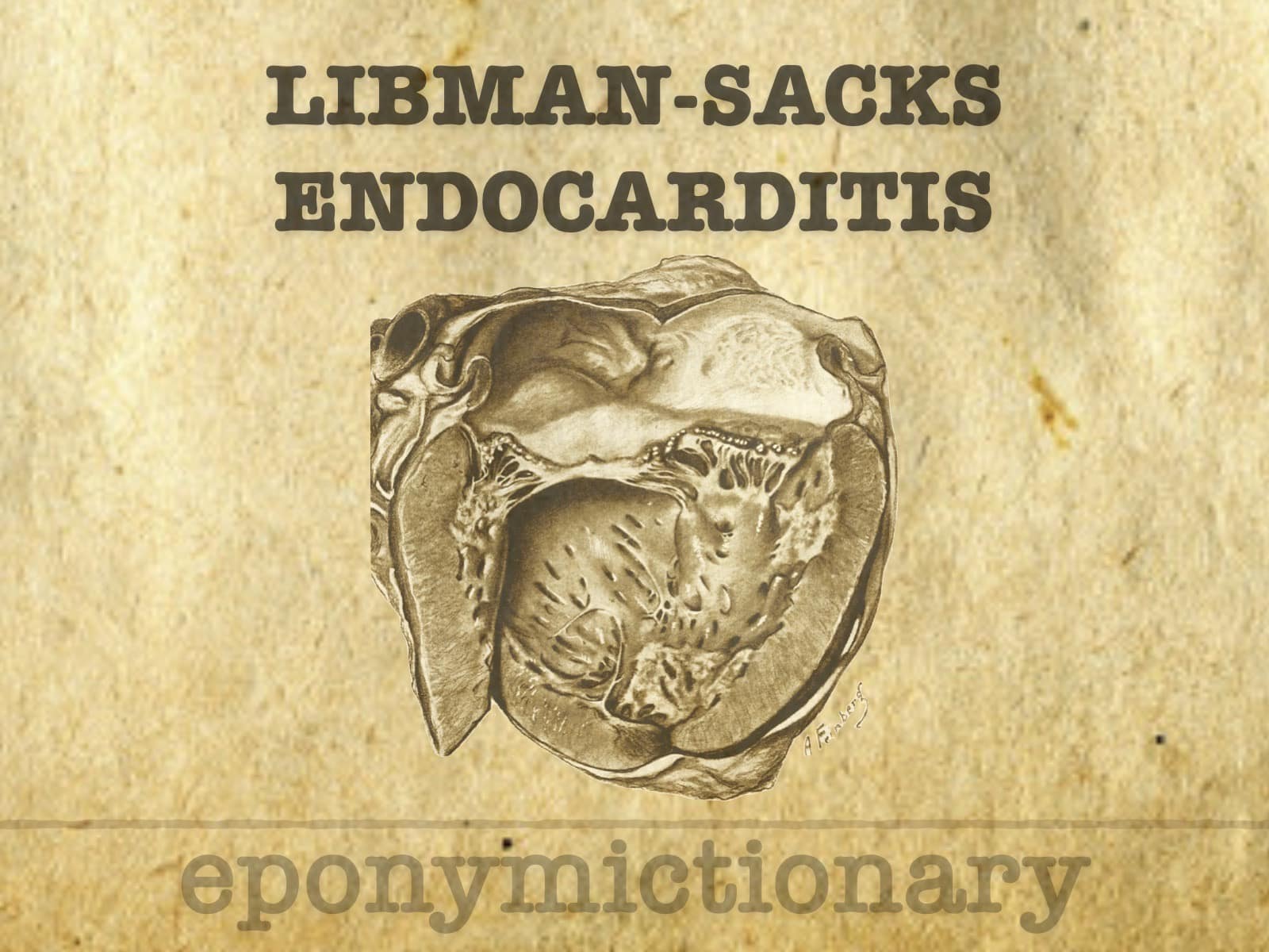 Libman Mio Libman-Sacks endocarditis Archives • LITFL