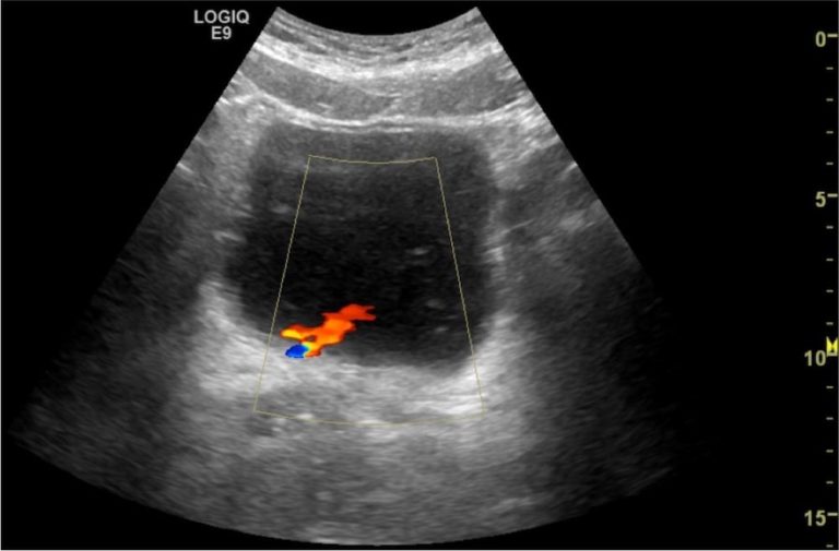 Distal VUJ stone Case 1 • LITFL • Ultrasound Clinical Cases