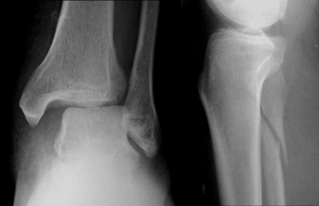 Maisonneuve fracture