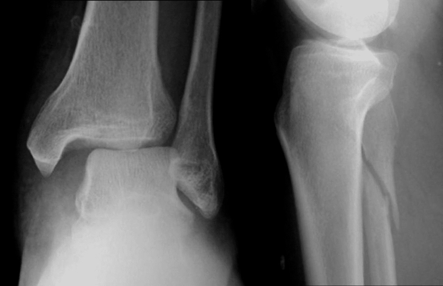 Bimalleolar ankle fracture, Radiology Case