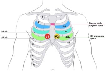 Misplacement of V1 and V2 • LITFL • ECG Library Basics