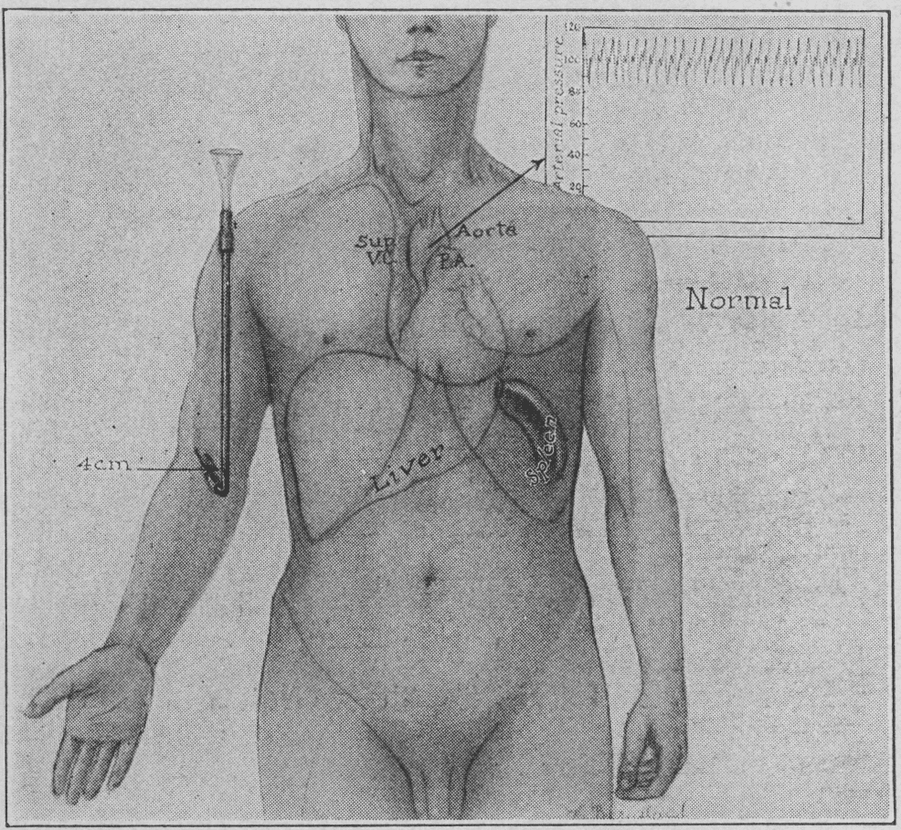 Beck's triad - normal circulation- 1935