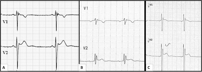 Figure 5 false STEMI with V1 and V2 placement