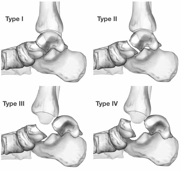 types of talus fractures