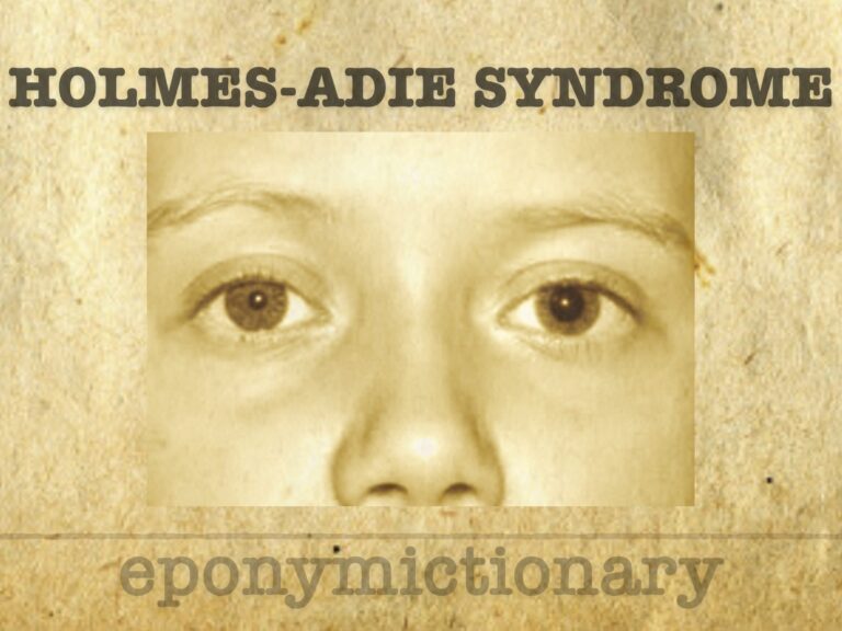Holmes-Adie syndrome 680