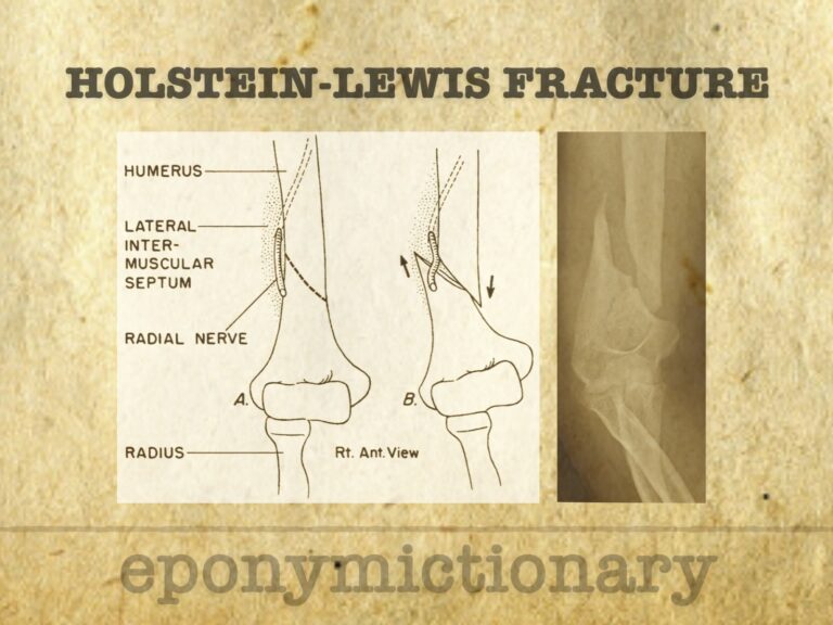 Holstein–Lewis fracture 680