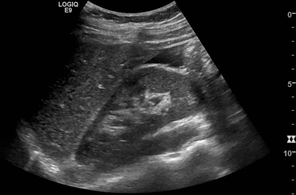 Image 1_Case 013_ruptured ectopic_RUQ