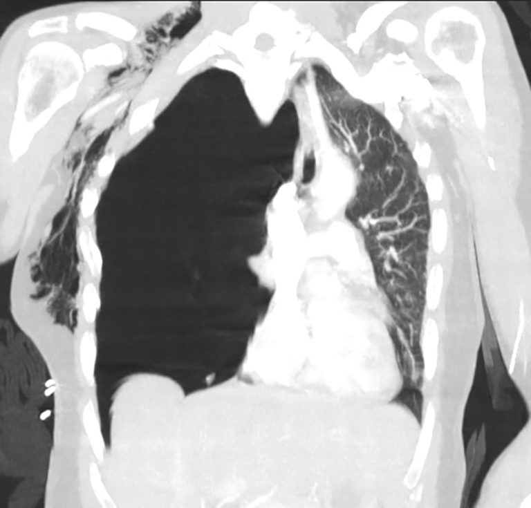 Subcutaneous emphysema • LITFL • Ultrasound library clinical case