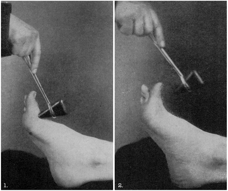 Tom Throckmorton • LITFL • Medical Eponym Library