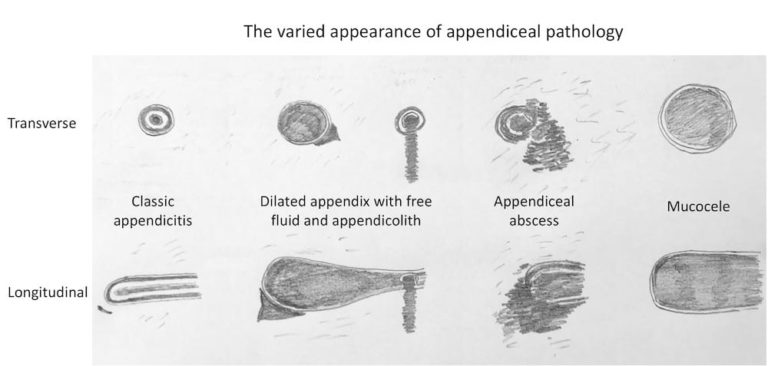 Ultrasound Case 083 • LITFL • POCUS Self-Assessment Quiz