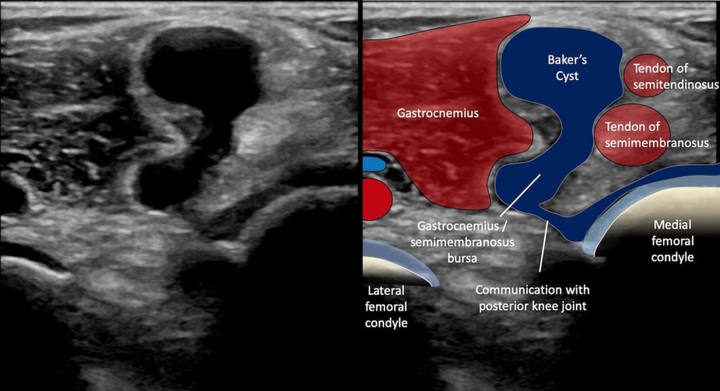 Ultrasound Case 098 • LITFL • POCUS Self-Assessment Quiz