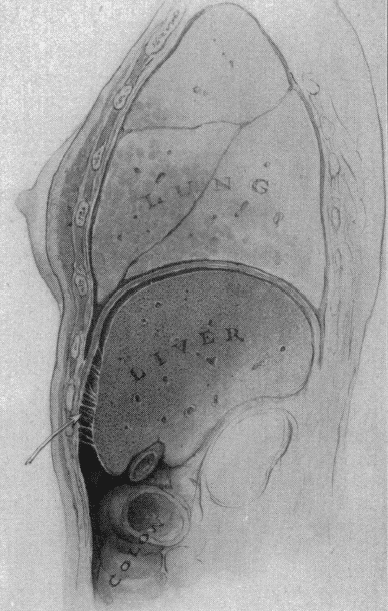 Violin-string or banded adhesions Curtis 1930