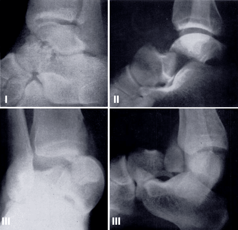 types of talus fractures