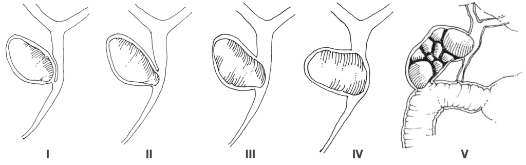 Mirizzi syndrome - Beltrán modified Csendes classification 2012