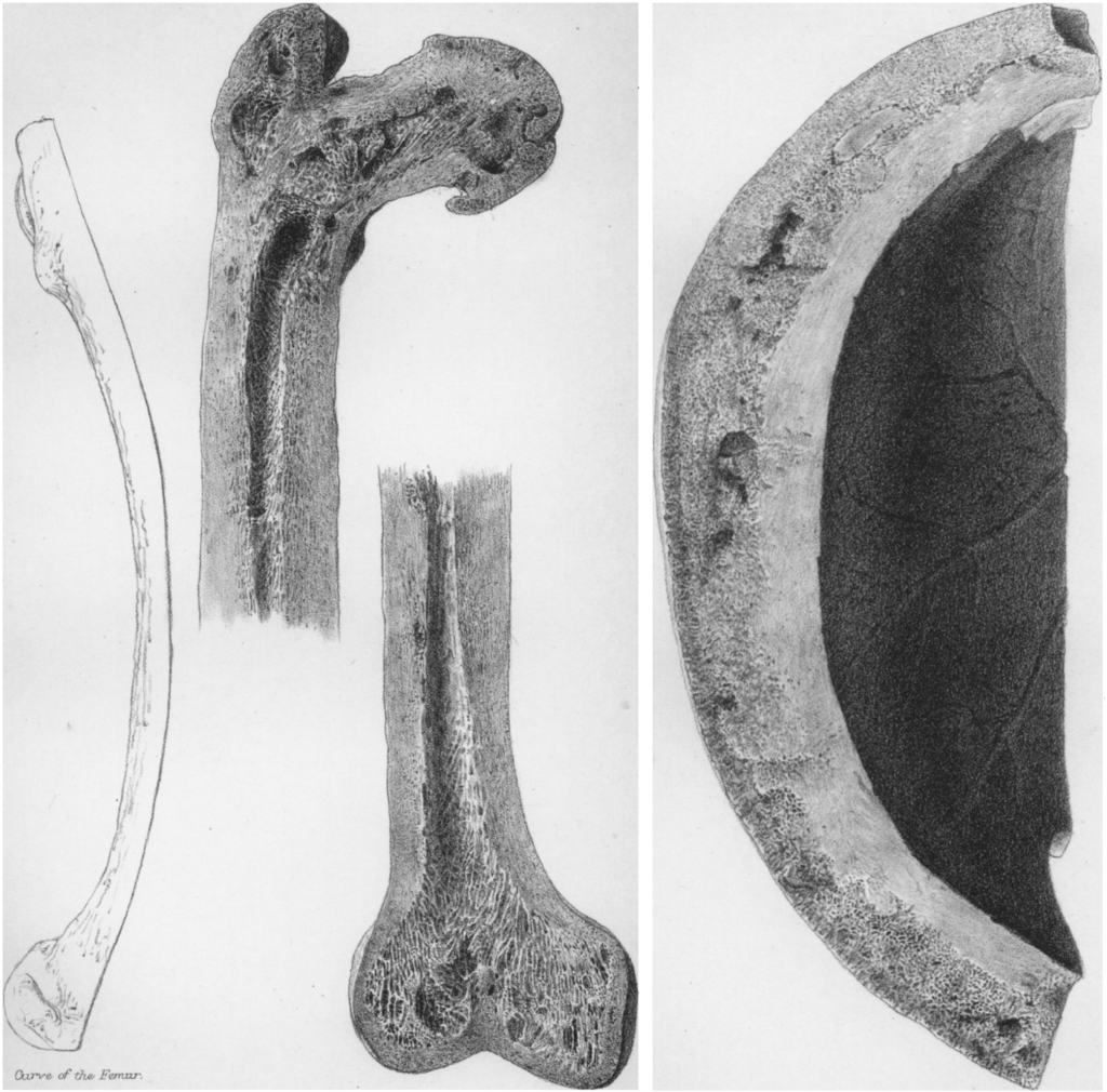 Paget 1876 Plate 4 and 5