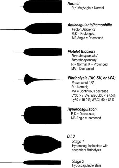 Thromboelastogram (TEG) • LITFL • CCC Investigations