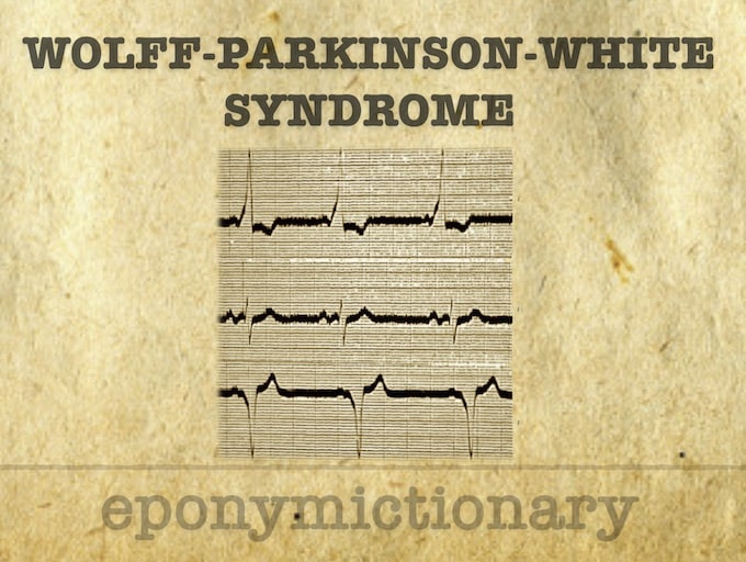 WPW syndrome 680