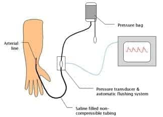 arterial line set up