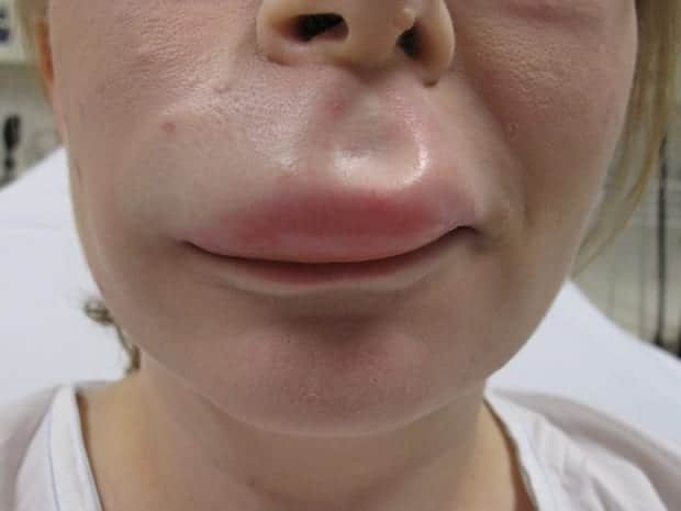 Is a swollen upper lip an allergic reaction