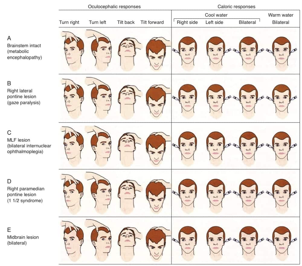 Oculocephalic and oculovestibular reflexes • LITFL• CCC