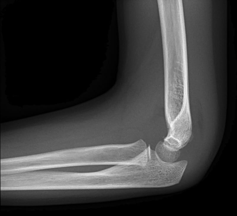 supracondyar fracture pediatric ortho