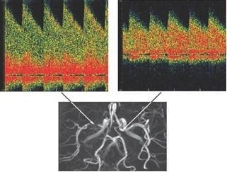 transcranial doppler machines