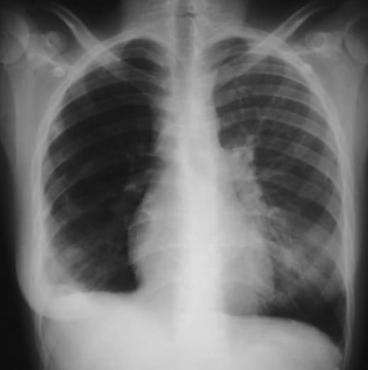 westermark sign oligemia pulmonary embolus