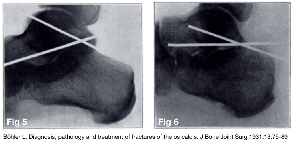 Böhler L. Diagnosis, pathology and treatment of fractures of the os calcis