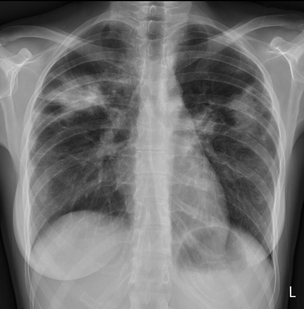 Löffler syndrome CXR AP