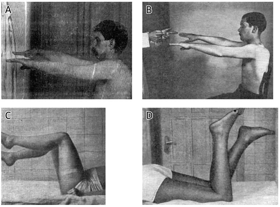 Mingazzini test and Barré test