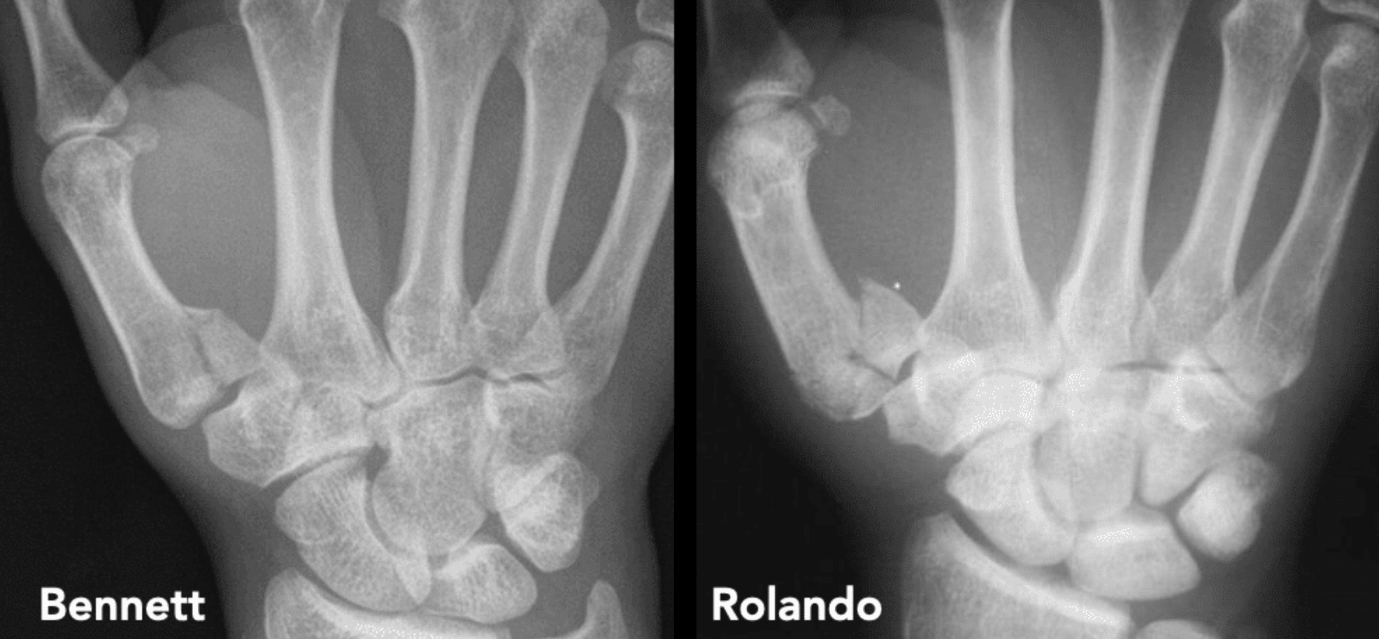 Rolando Bennet fractures compared 1