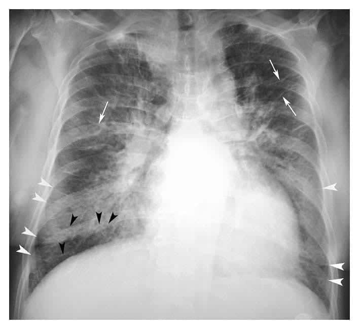 cephalization of pulmonary vessels